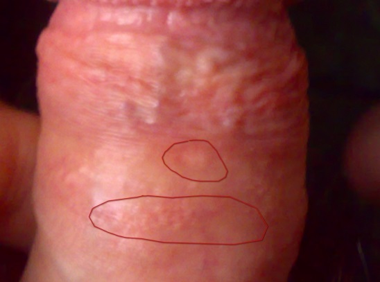 Проявление воспаления крайней плоти у мужчин