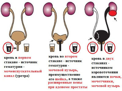 Гематурия и ее различные причины