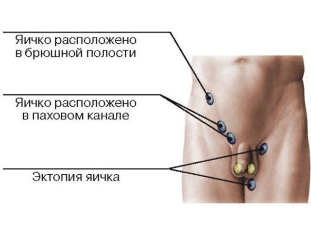 Эктопия яичка у детей