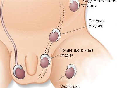Показания к орхопексии