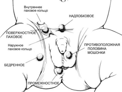 Лечение крипторхизма