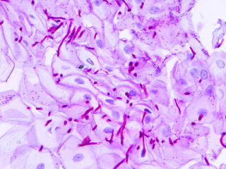 Candida albicans: основной возбудитель молочницы