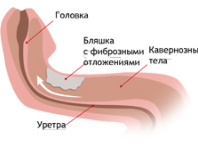Искривление пениса