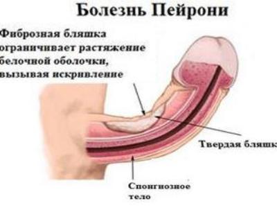 Изогнутый половой член
