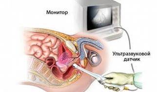 Схема проведения УЗИ простаты