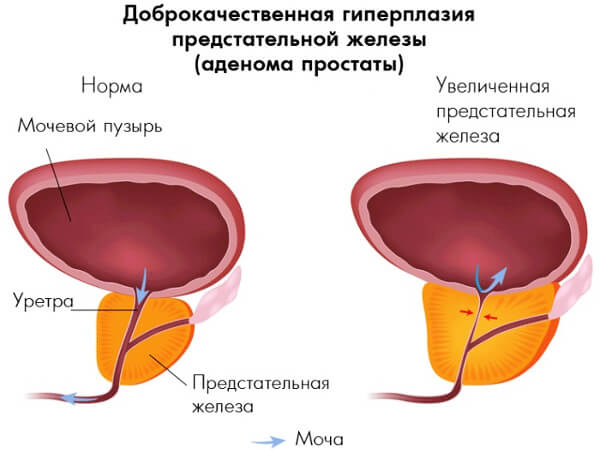 Что такое гиперплазия простаты