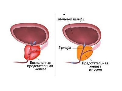 Размеры предстательной железы в норме