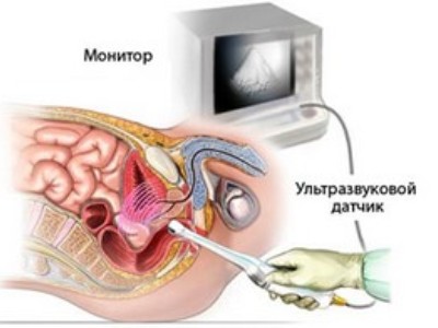 УЗИ мочевого пузыря и простаты