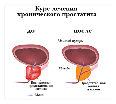 Схема курса лечения простатита