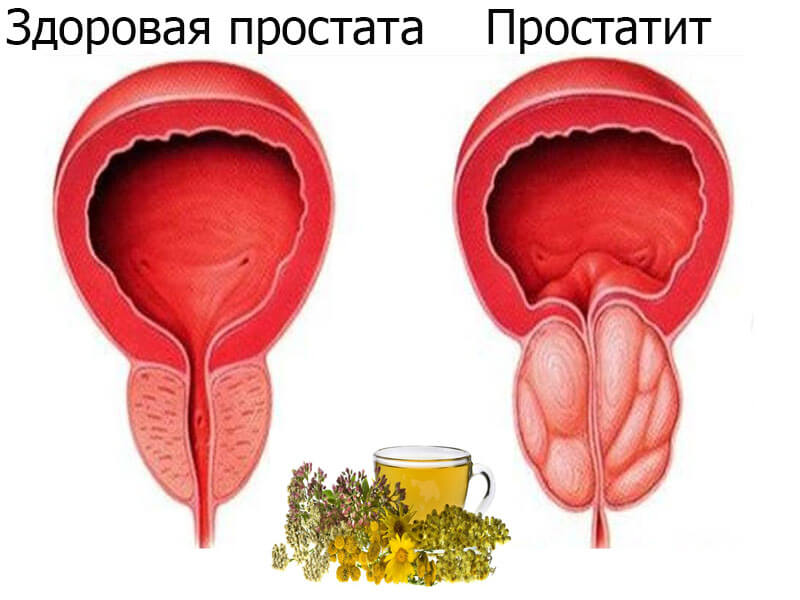 Лечение острого и хронического простатита травами