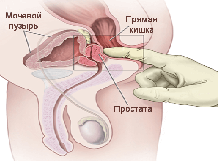 Схема массажа предстательной железы