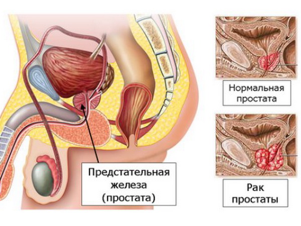 Проявления рака простаты