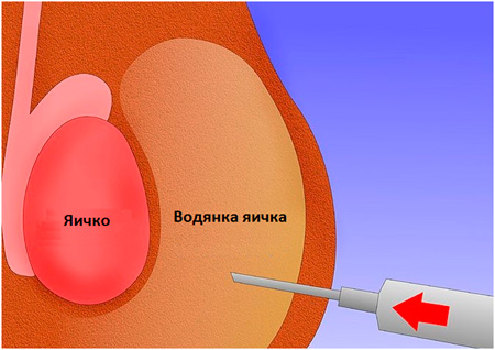 Основной путь передачи уреаплазмоза &mdash; половой контакт