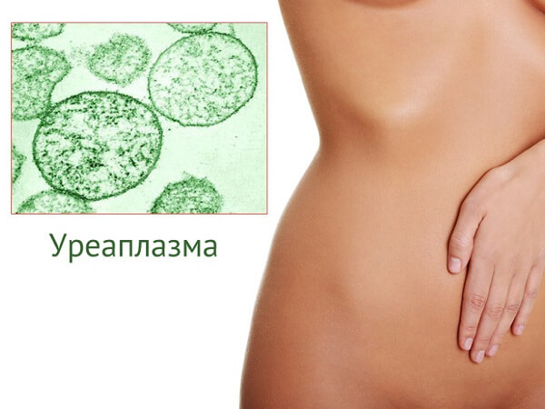 Как проявляется уреаплазмоз у женщин