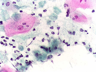 Trichomonas vaginalis &mdash; возбудитель данного вида уретрита