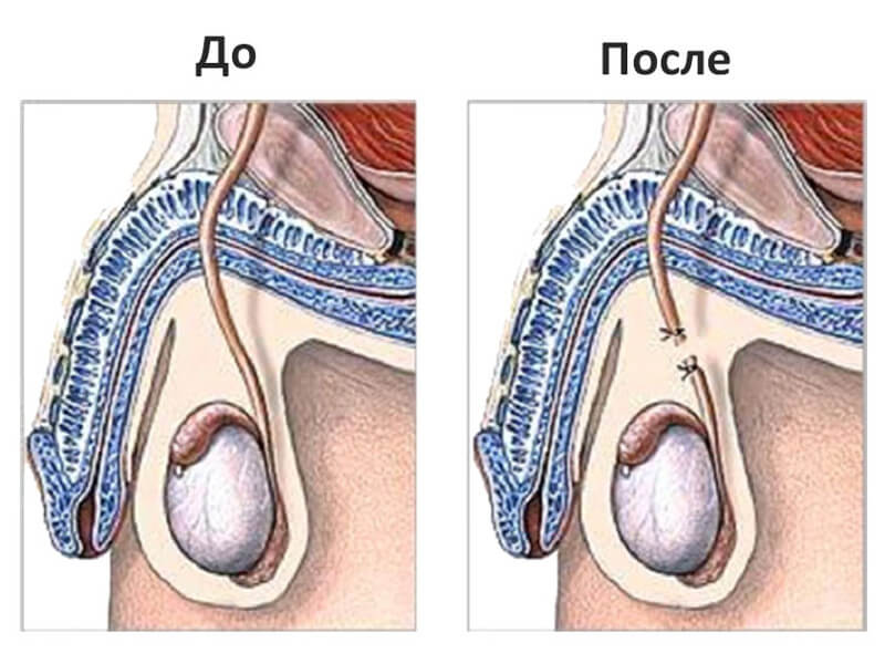 Что такое вазэктомия?