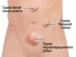 Грыжа