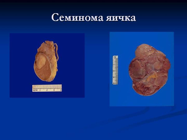Как выглядит семинома яичка