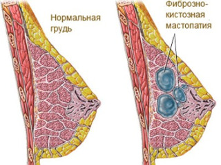 Кистозно-фиброзная мастопатия