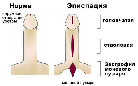 Эписпадия и другие детские урологические заболевания