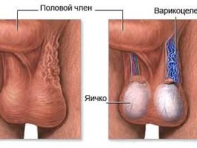 Двухстороннее варикоцеле