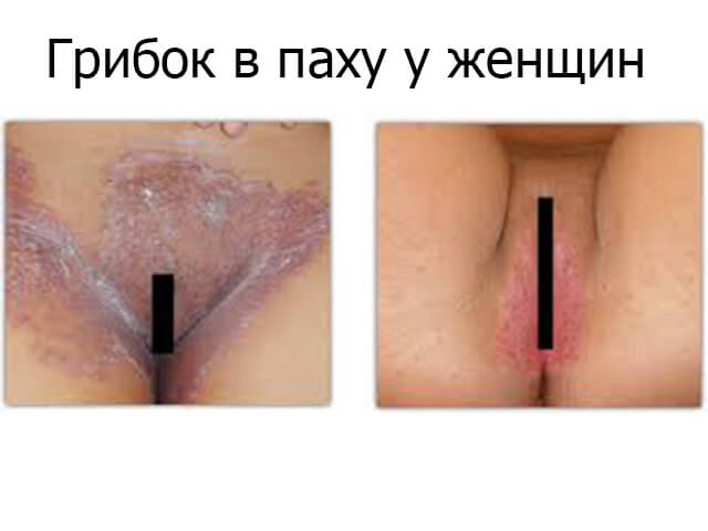 Взятие мазка